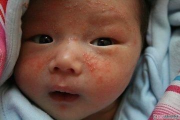 小儿湿疹有什么症状