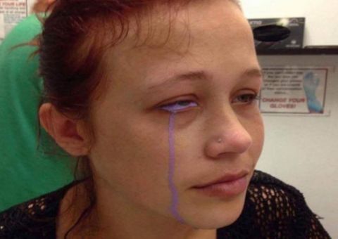 26岁女子纹眼球失败眼泪竟是蓝色的,医生看
