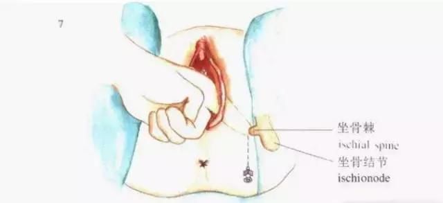 象妈妈跟你说,会阴侧切,这一刀你可能白挨了!