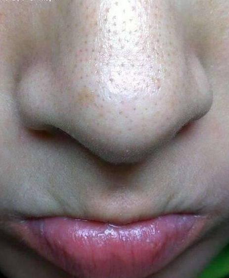 毛孔里的小颗粒怎么都挤不完,只要碰上这3物,