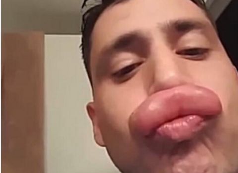 男子嘴巴变成香肠嘴,笑死一堆人,得知原因后有