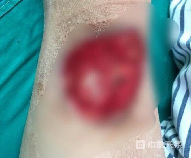 南昌一女子做丰臀手术被严重烧伤 美容机构:仪
