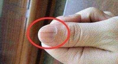 指甲上出现这些竖纹,真的是患了癌症?真相是