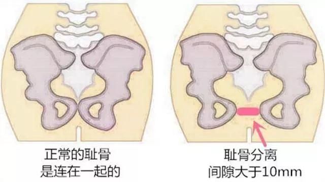 产后腹直肌分离怎么办？教你4种治疗手法，2个锻炼动作