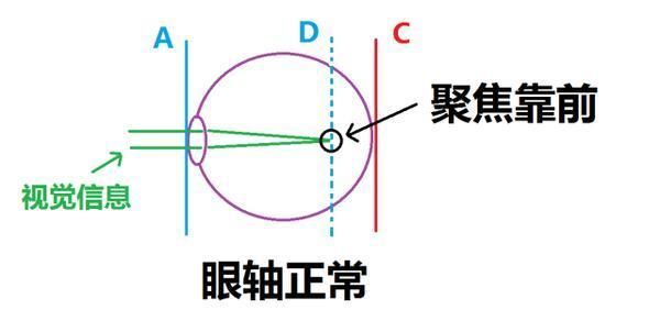 近视真的可以靠肌肉锻炼来恢复视力吗?不要再轻信谣言了