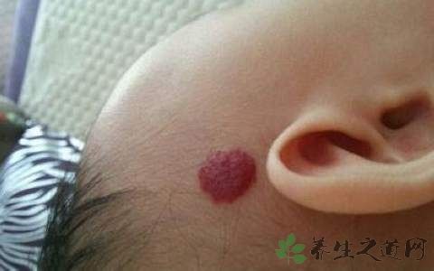 血管瘤塞可以治愈吗