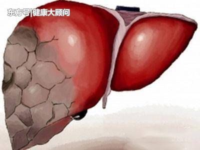 19岁女大学生查出肝癌离世，医生解释：1个习惯害的！