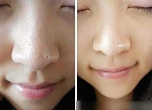 自己挤出黑头后怎么做