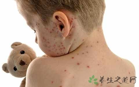 儿童为什么易发类风湿病