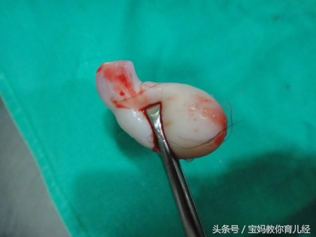 42岁高龄产妇顺产27天后,突然掉出一大块肉,医生检查后怒斥无知